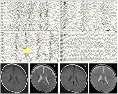 West Syndrome in an Infant With Vitamin B12 Deficiency Born to Autoantibodies Positive Mother